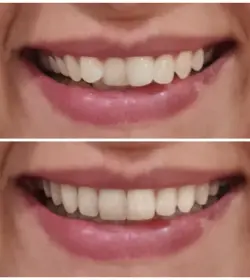 Aligner treatment before and after