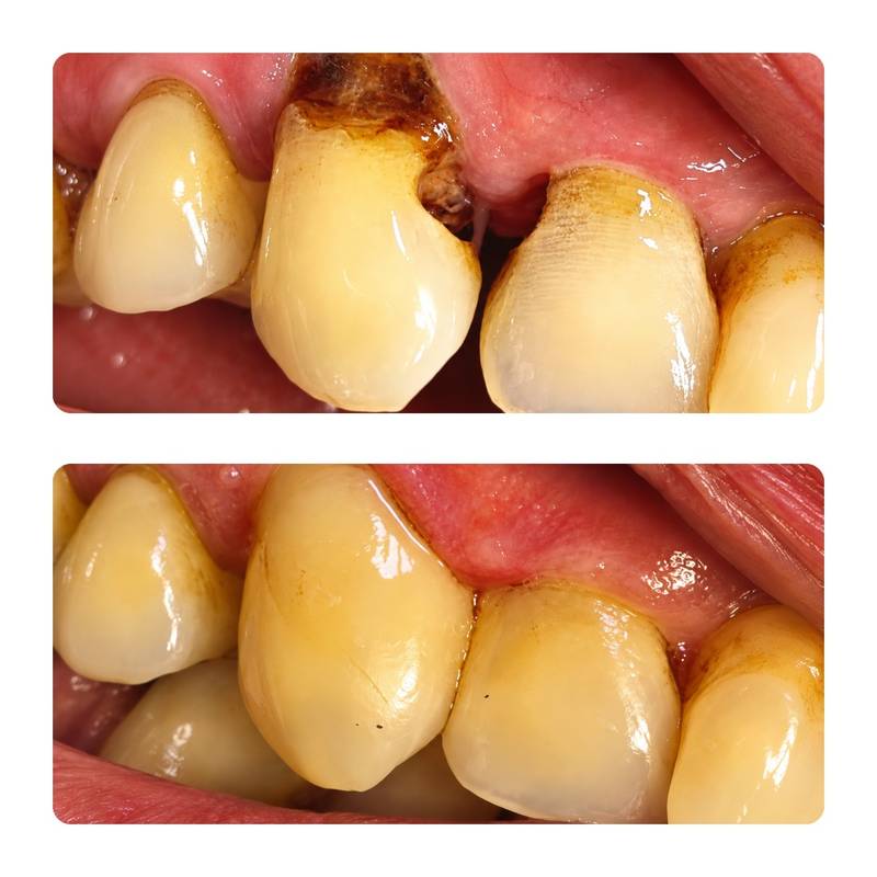 Anterior crown restoration before and after