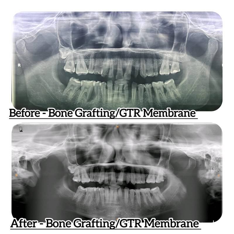 Bone grafting and GTR membrane treatment before and after