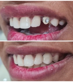 Dental bridge before and after