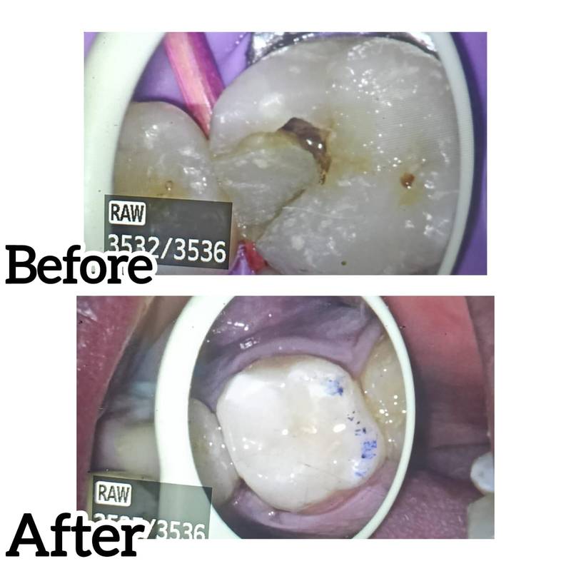 Composite dental restoration before and after