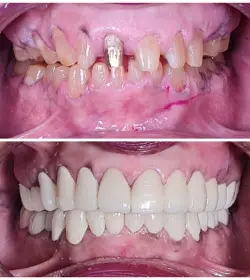 Dental implant before and after