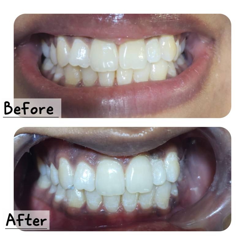 Smile makeover before and after