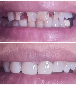 Smile design before and after