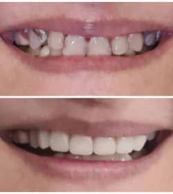 Smile makeover before and after