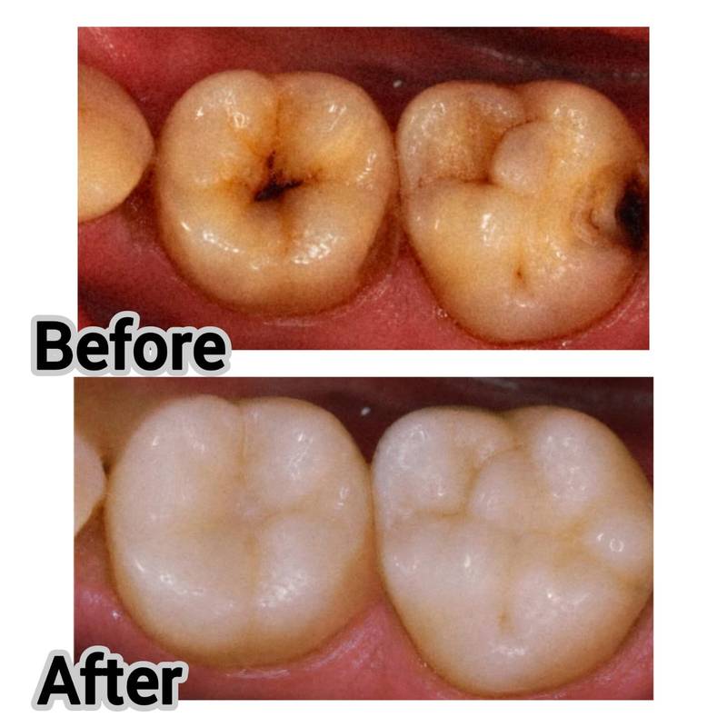 Tooth-coloured fillings before and after