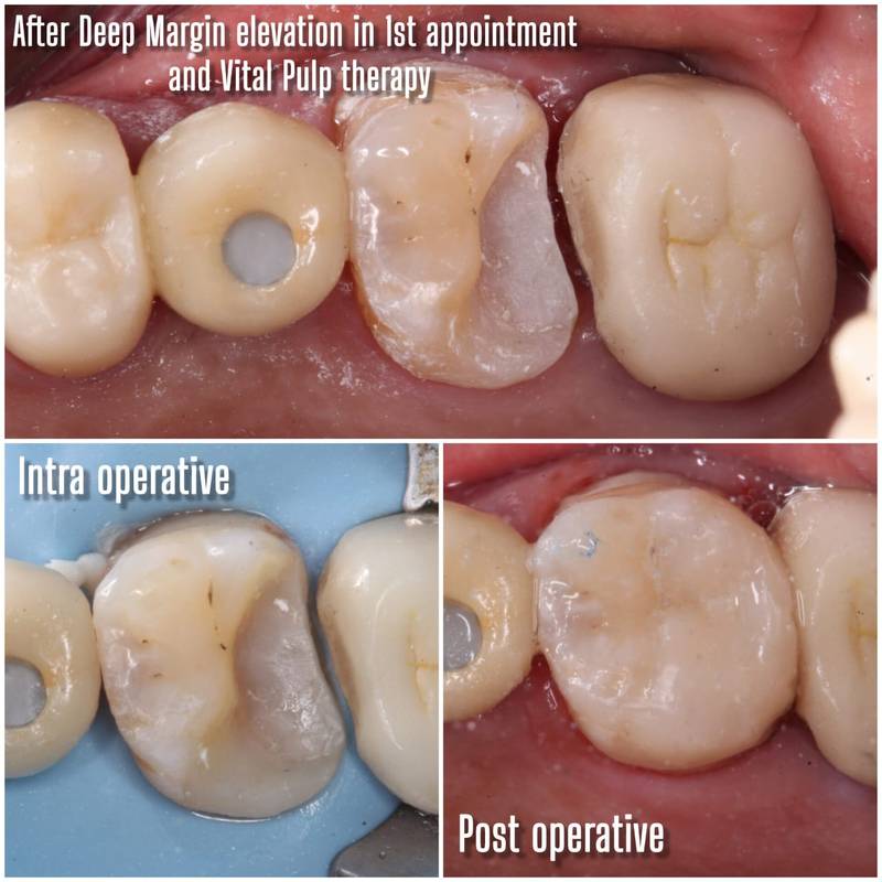 Deep margin elevation and vital pulp therapy